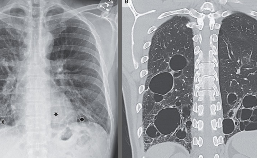 Синдром Шёгрена привел к крупным кистам в легких американца